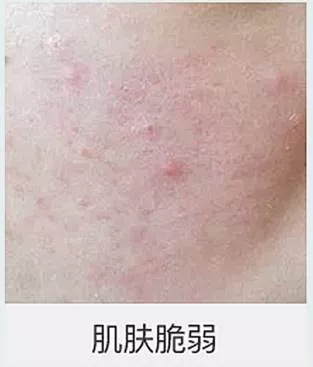 是缺少微量元素的原因导致的，提议你适当的能够多及时补充一些微量元素的，皮肤弹性差缺少维生素C的问题。