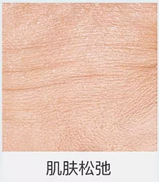 皮肤松弛没有弹性，会造成脸部出现严重皱纹。通常由于人体自然老化引起，表现为皮肤组织衰退和生理功能低下。