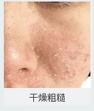年龄增长、气候变化、睡眠不足、过度疲劳，洗澡水过热、洗涤用品碱性强等都是导致皮肤干燥的重要原因。